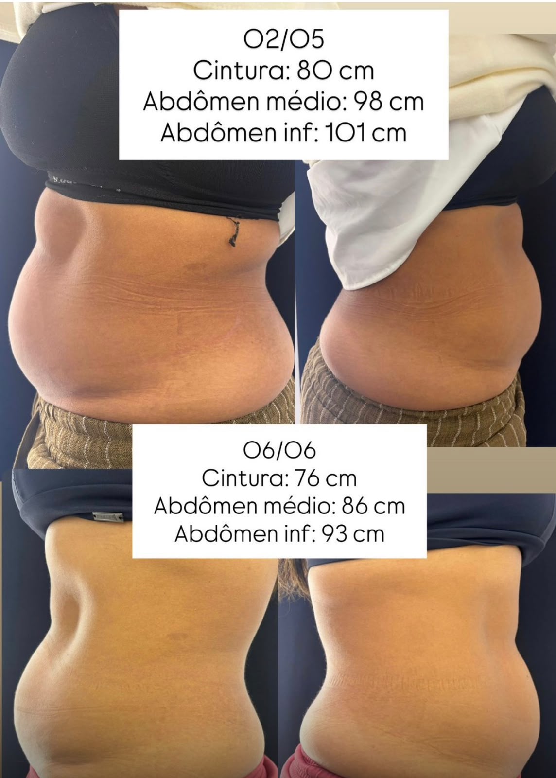 Resultado de Criolipólise na Dermós Clinic