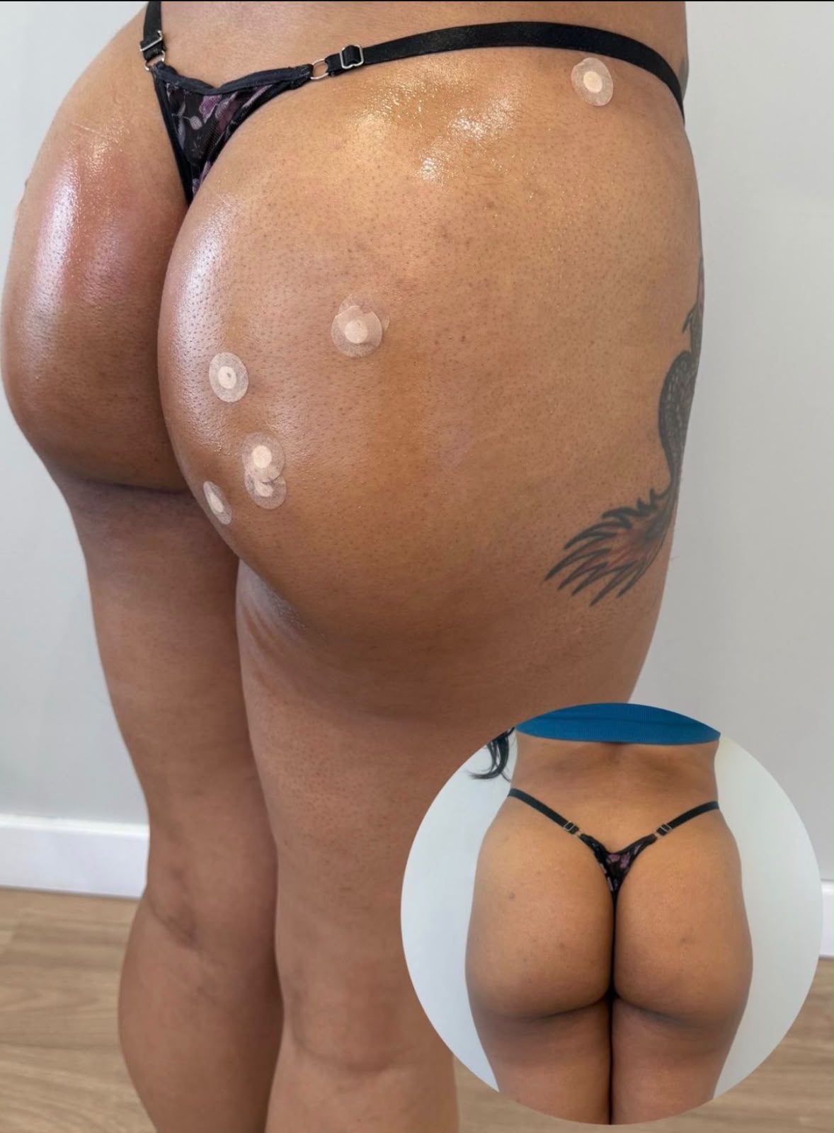 Resultado de Harmonização de Glúteo na Dermós Clinic