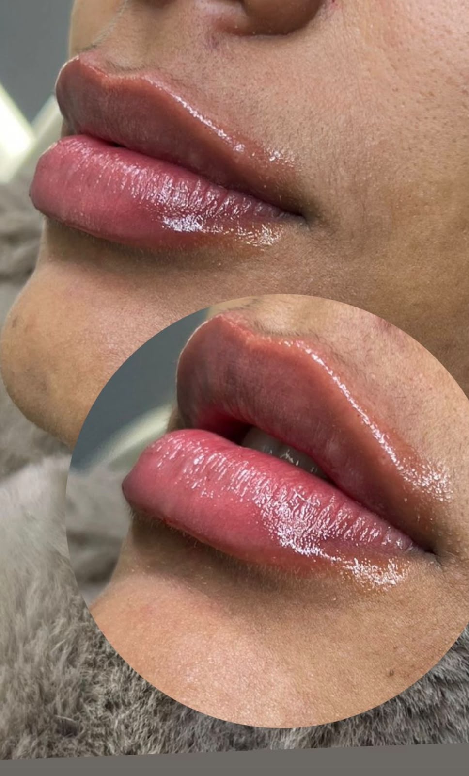 Resultado de Preenchimento Labial na Dermós Clinic