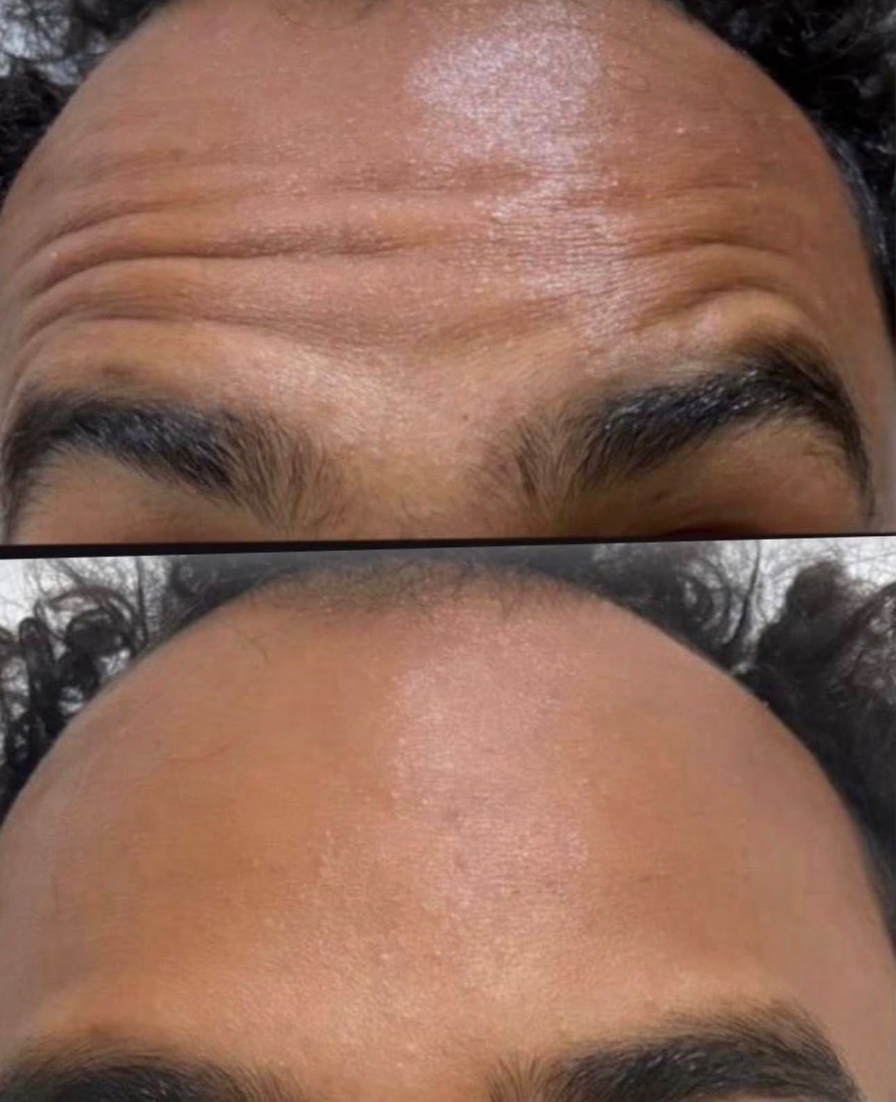 Resultado de Botox na Dermós Clinic