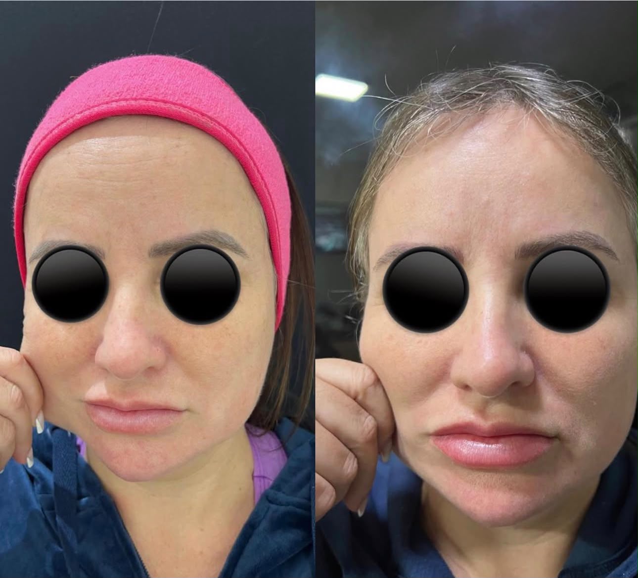 Resultado de Bioestimulador de Colágeno na Dermós Clinic